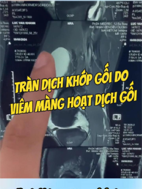 @Chuyên gia xương khớp