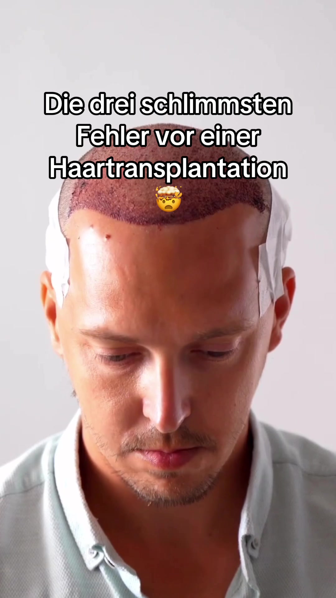 @Mr. Hairtransplant