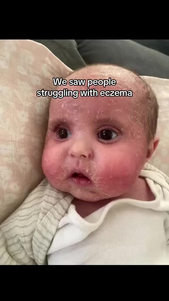 @Eczema Diaries USA & UK