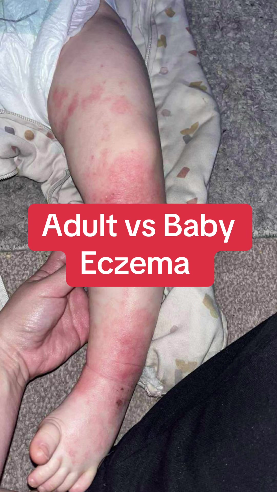 @Eczema Diaries USA & UK
