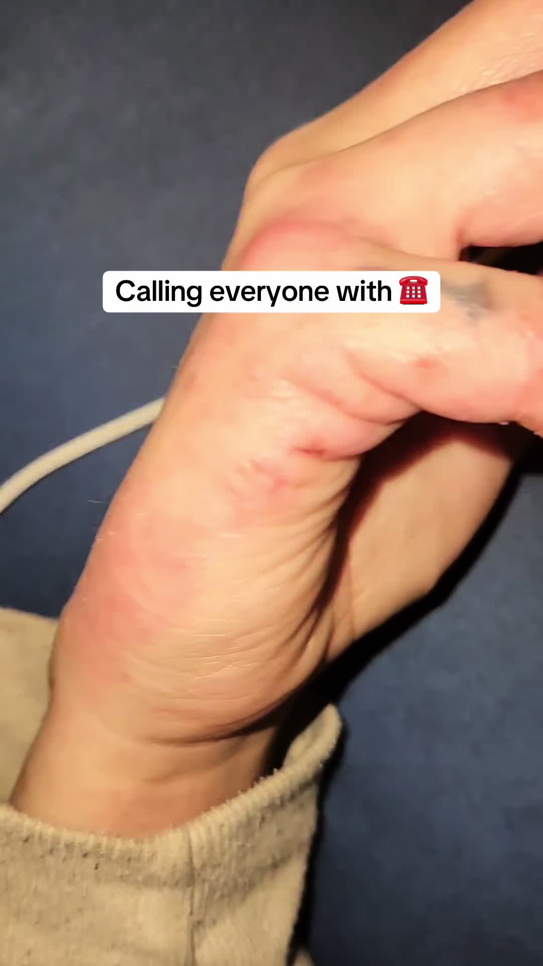 @Eczema Diaries USA & UK
