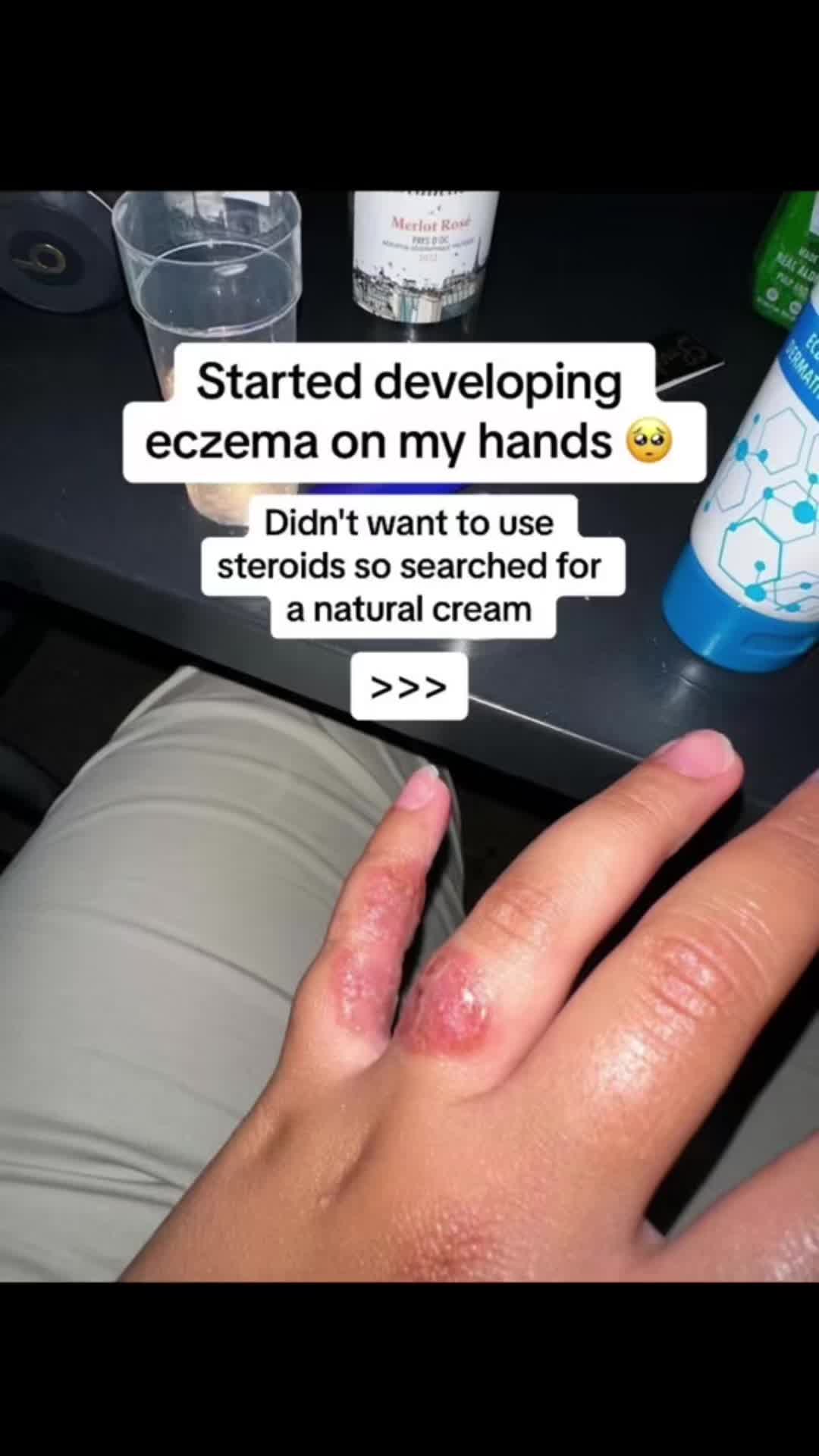 @Eczema Diaries USA & UK