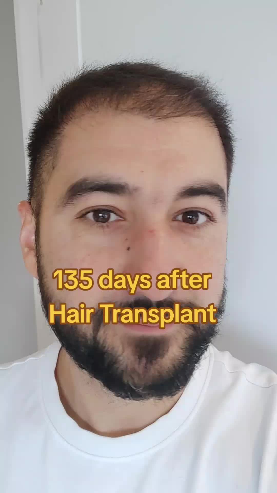 @My hair transplant