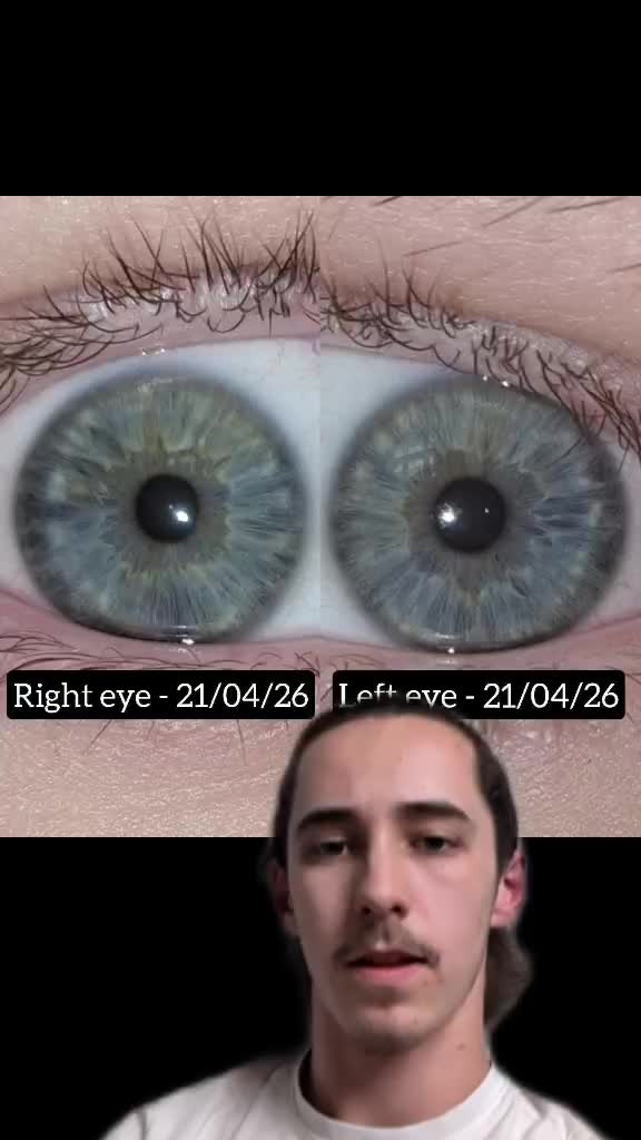 @Oliver | Aajonus' Iridology 👀
