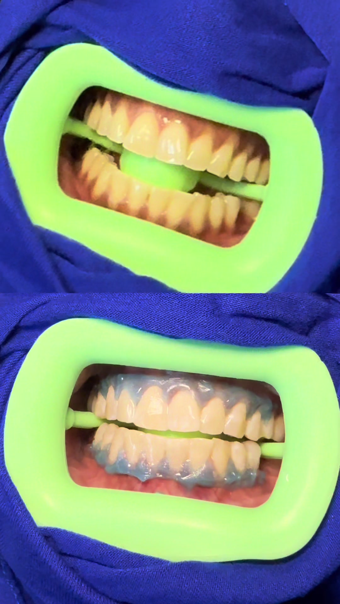 @Halal Teeth Whitening London