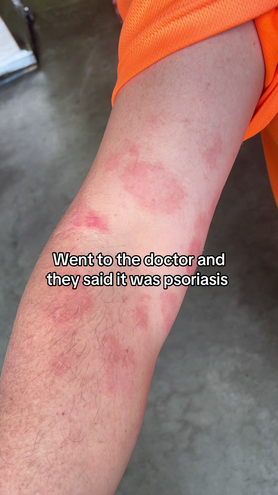 @Eczema Diaries USA & UK