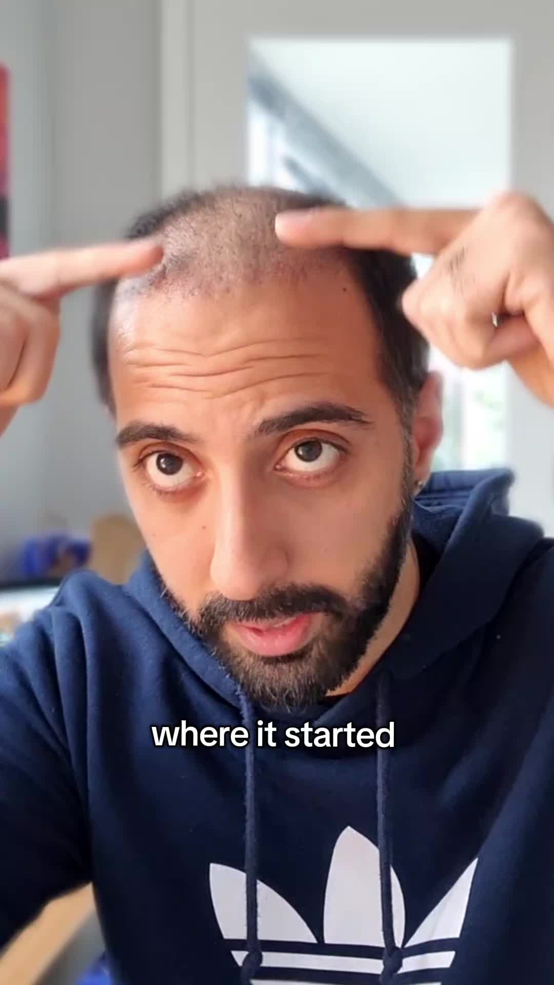 @Amit | Hair Transplant Tips