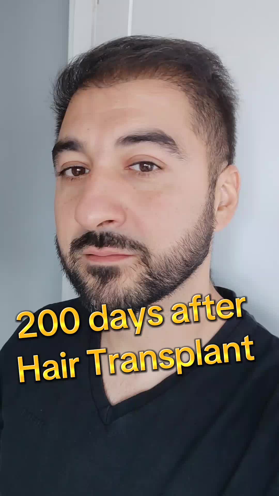 @My hair transplant