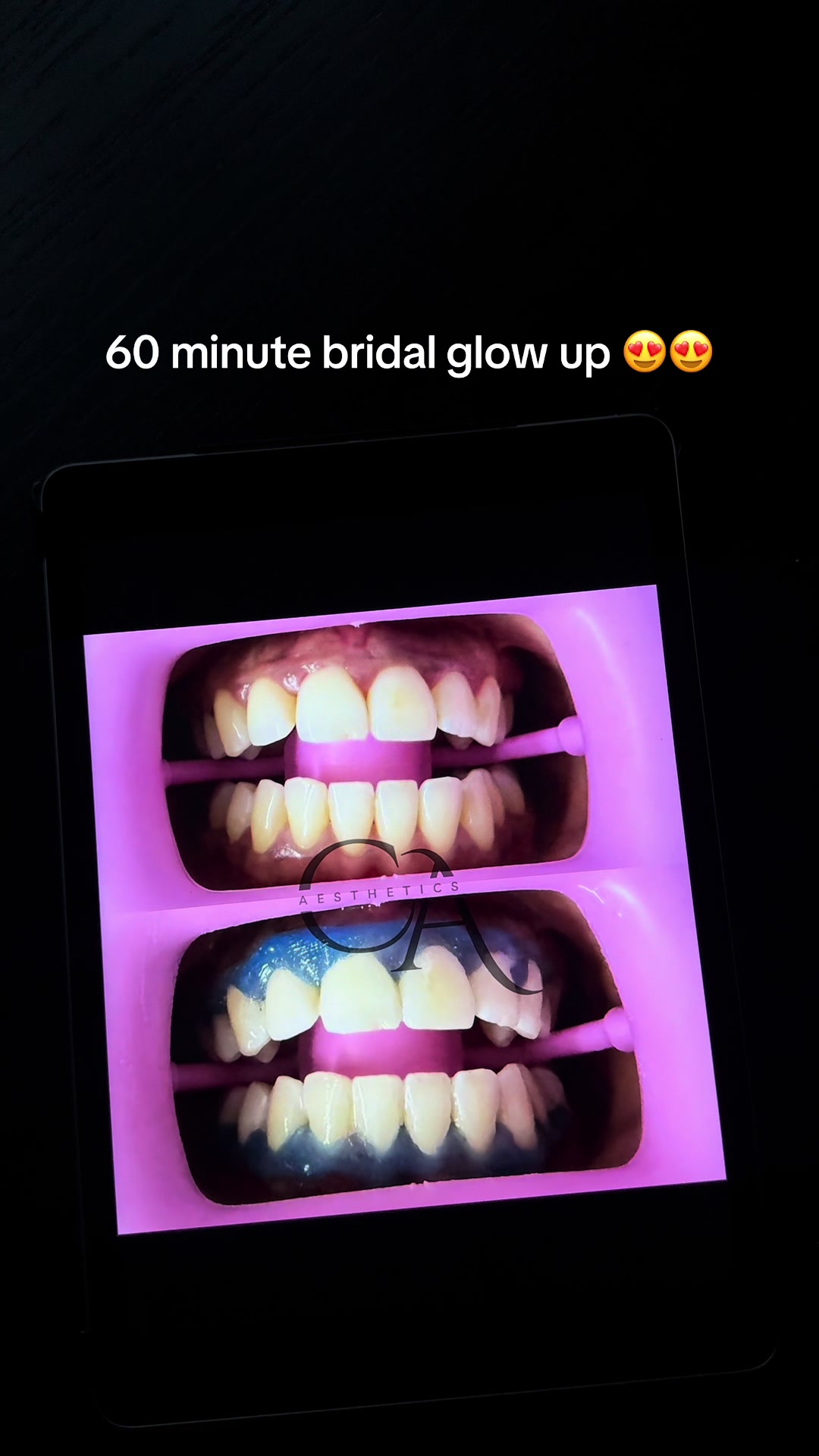 @Halal Teeth Whitening London