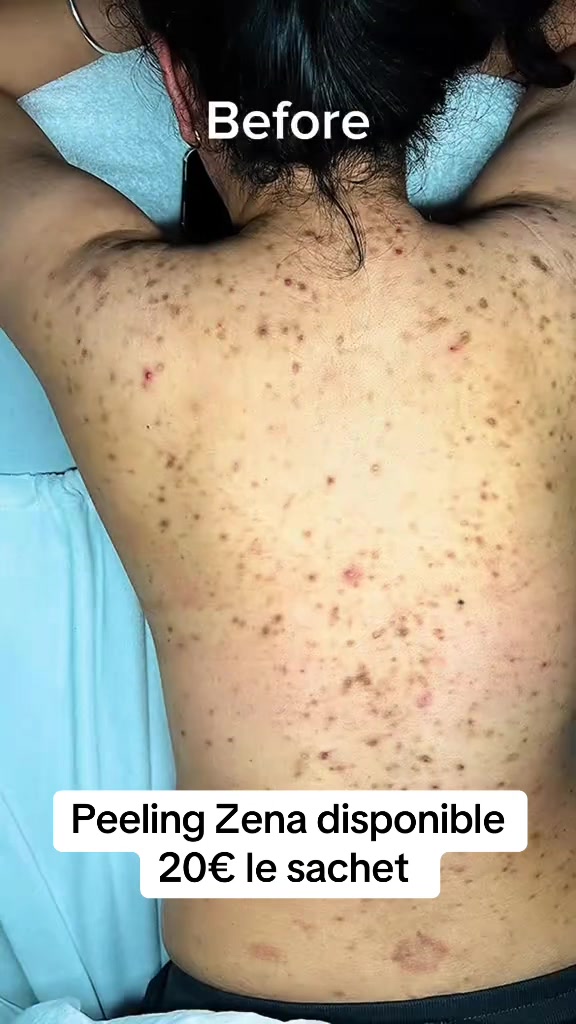 @peeling_zena