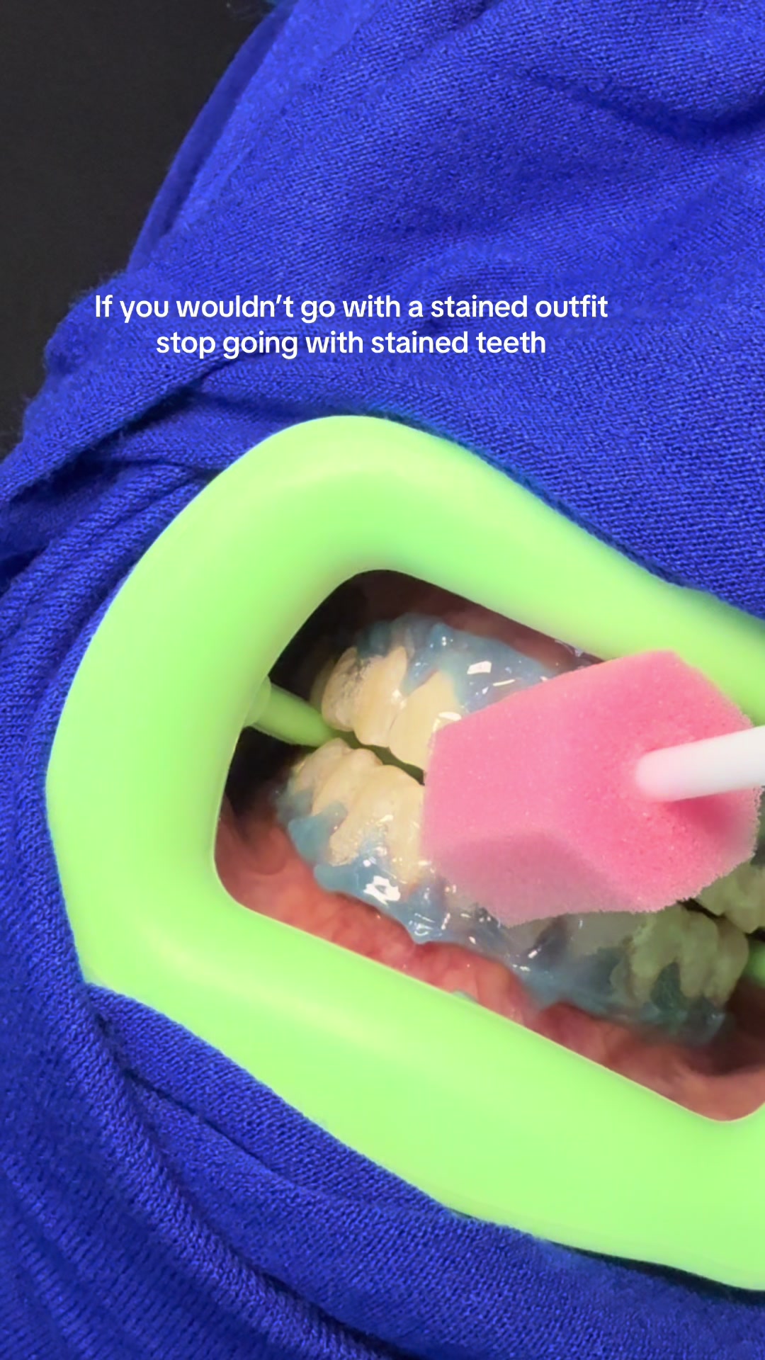 @Halal Teeth Whitening London