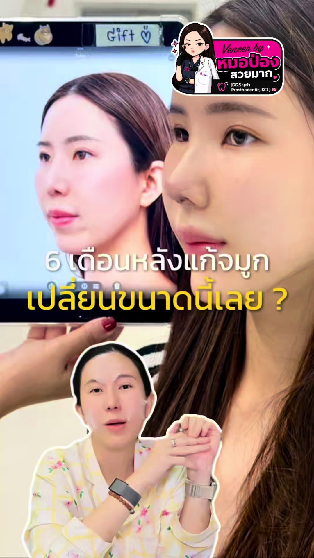@หมอป่องสวยมาก veneer 🦷
