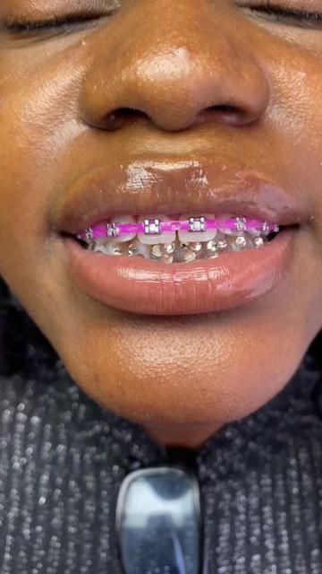 @Braces.bymavi|Smile Aesthetics
