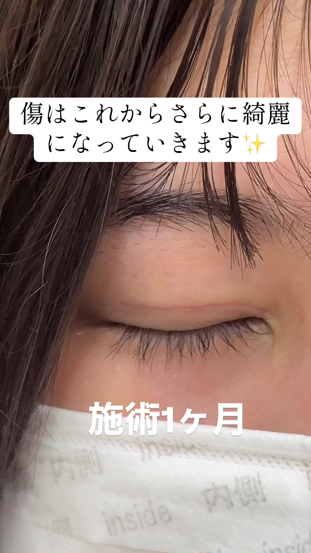 @二重整形埋没法/広島美容外科メイプルクリニック院長 吉本如良