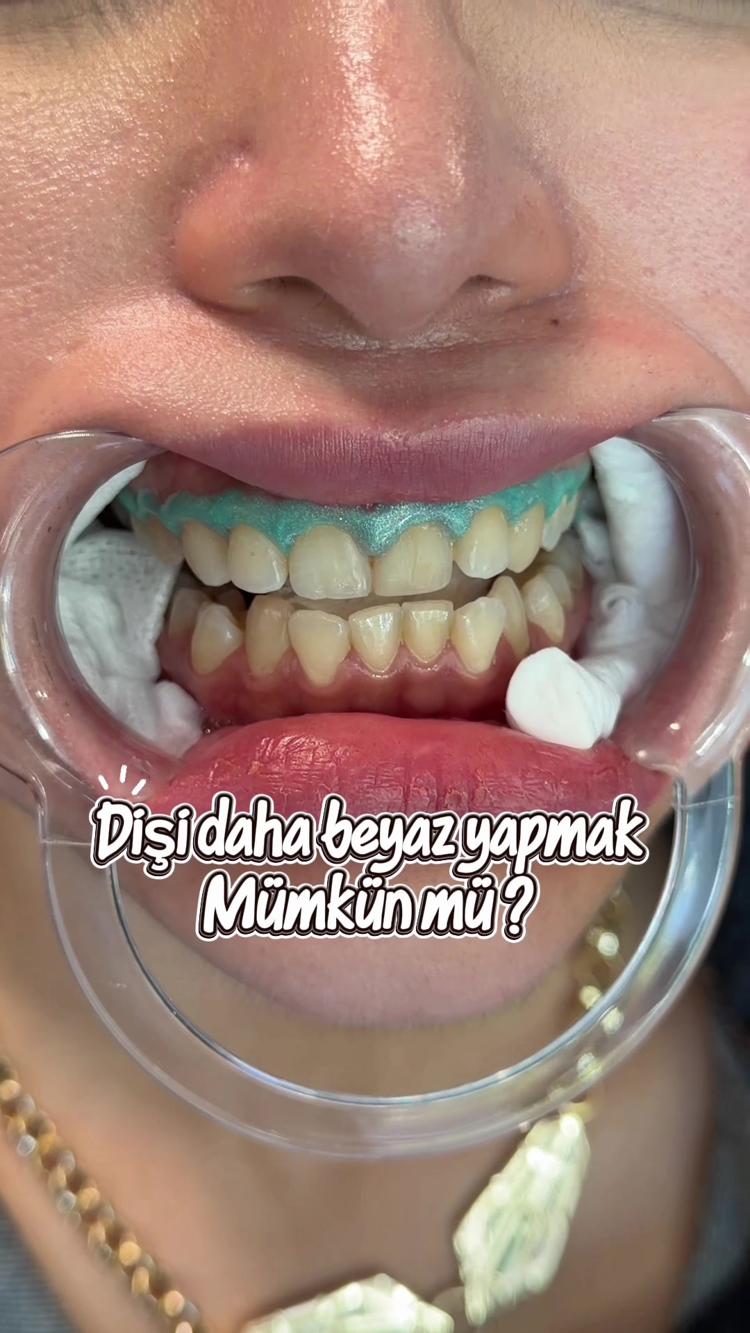 @Diş Hekimi Handenur Duru