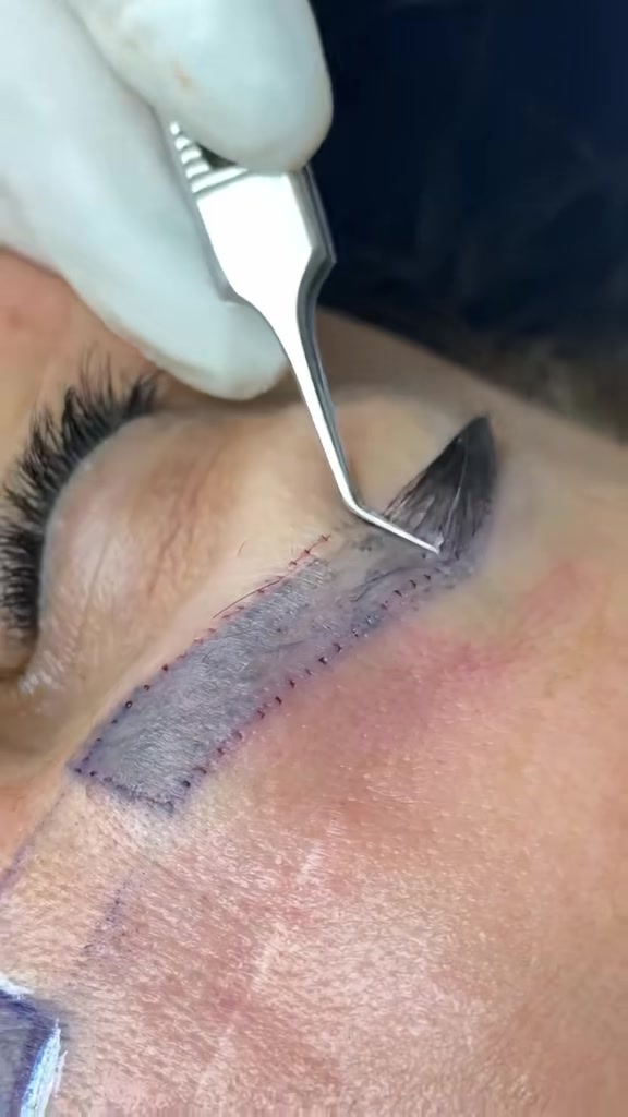 @Eyebrows Transplant