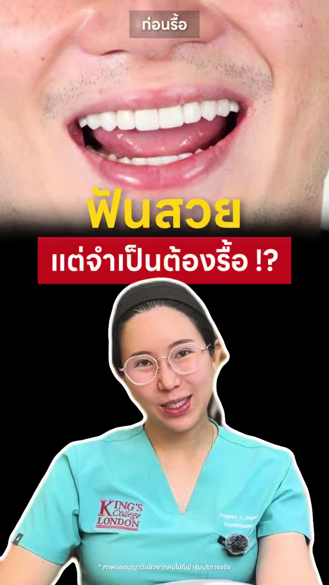 @หมอป่องสวยมาก veneer 🦷