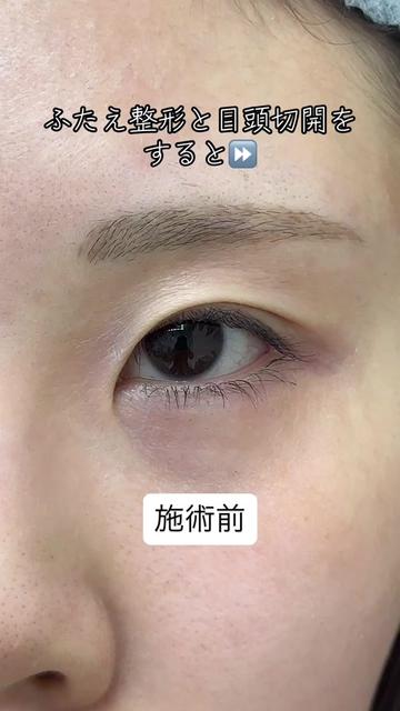 @二重整形埋没法/広島美容外科メイプルクリニック院長 吉本如良