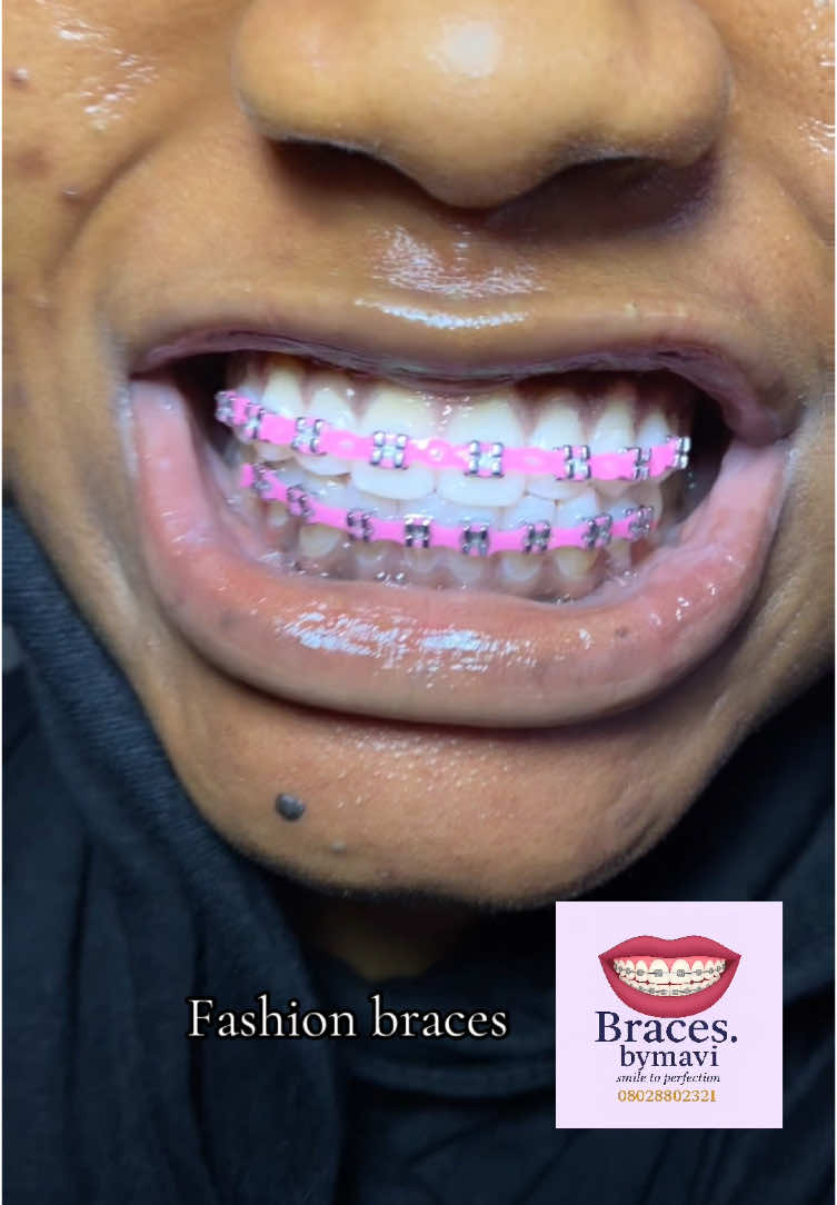 @Braces.bymavi|Smile Aesthetics