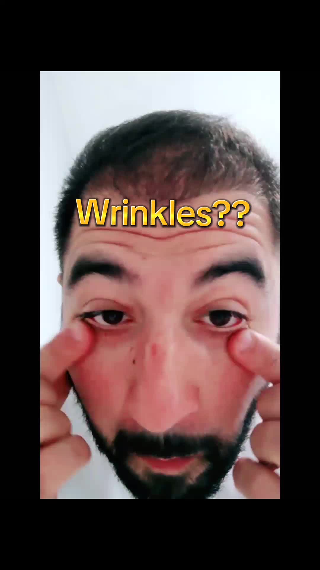 @My hair transplant