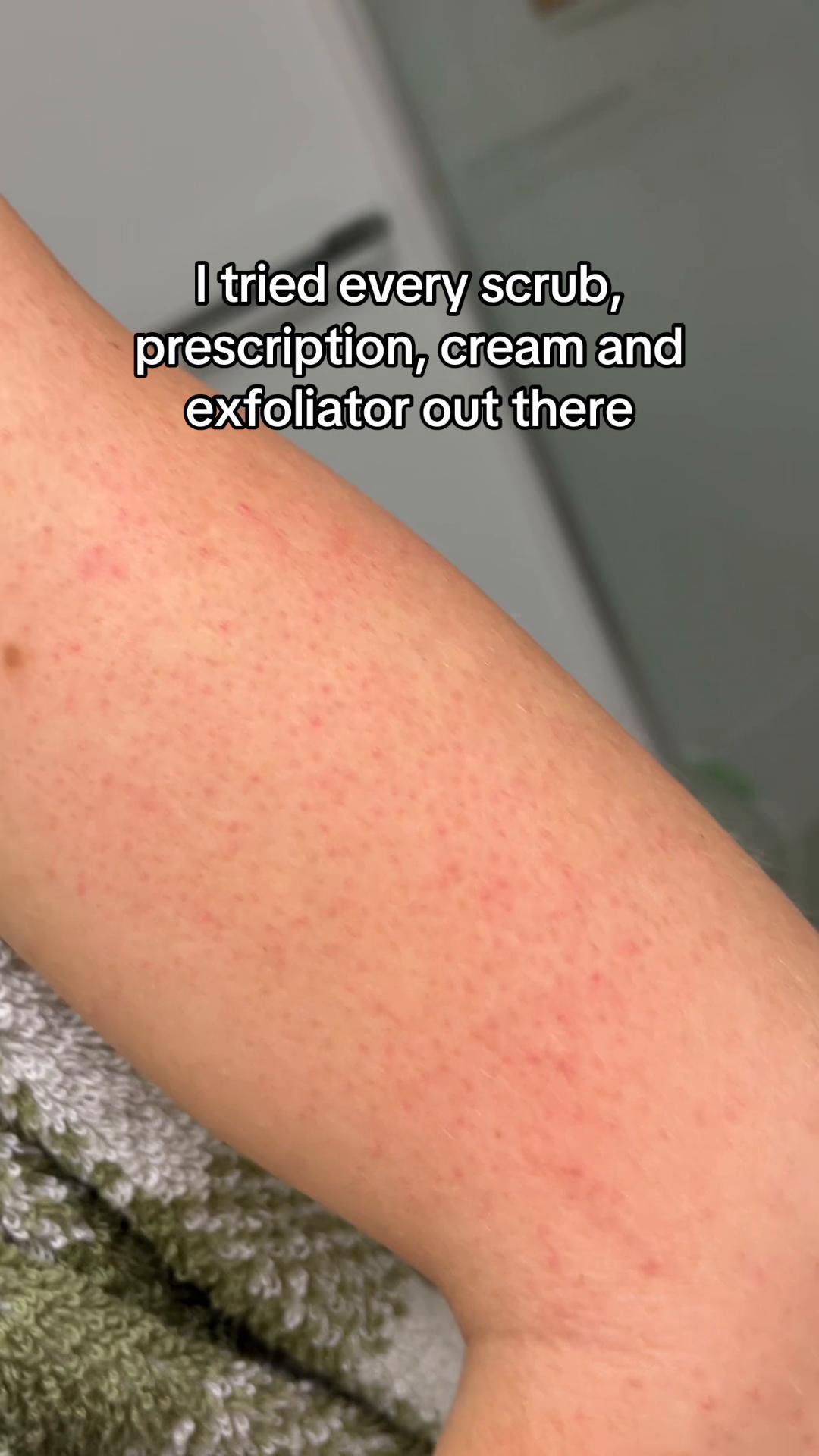 @Eczema Diaries USA & UK