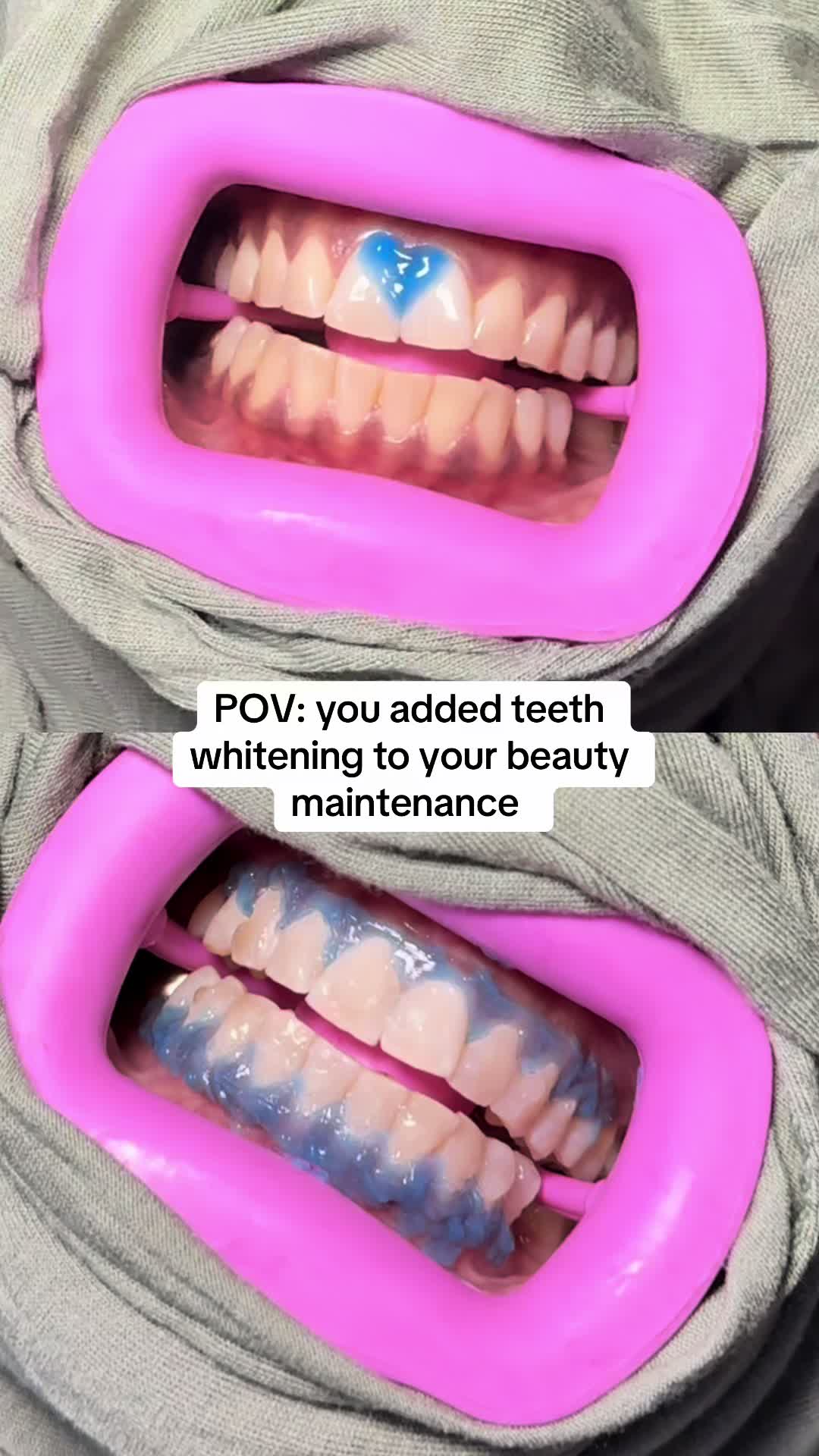 @Halal Teeth Whitening London