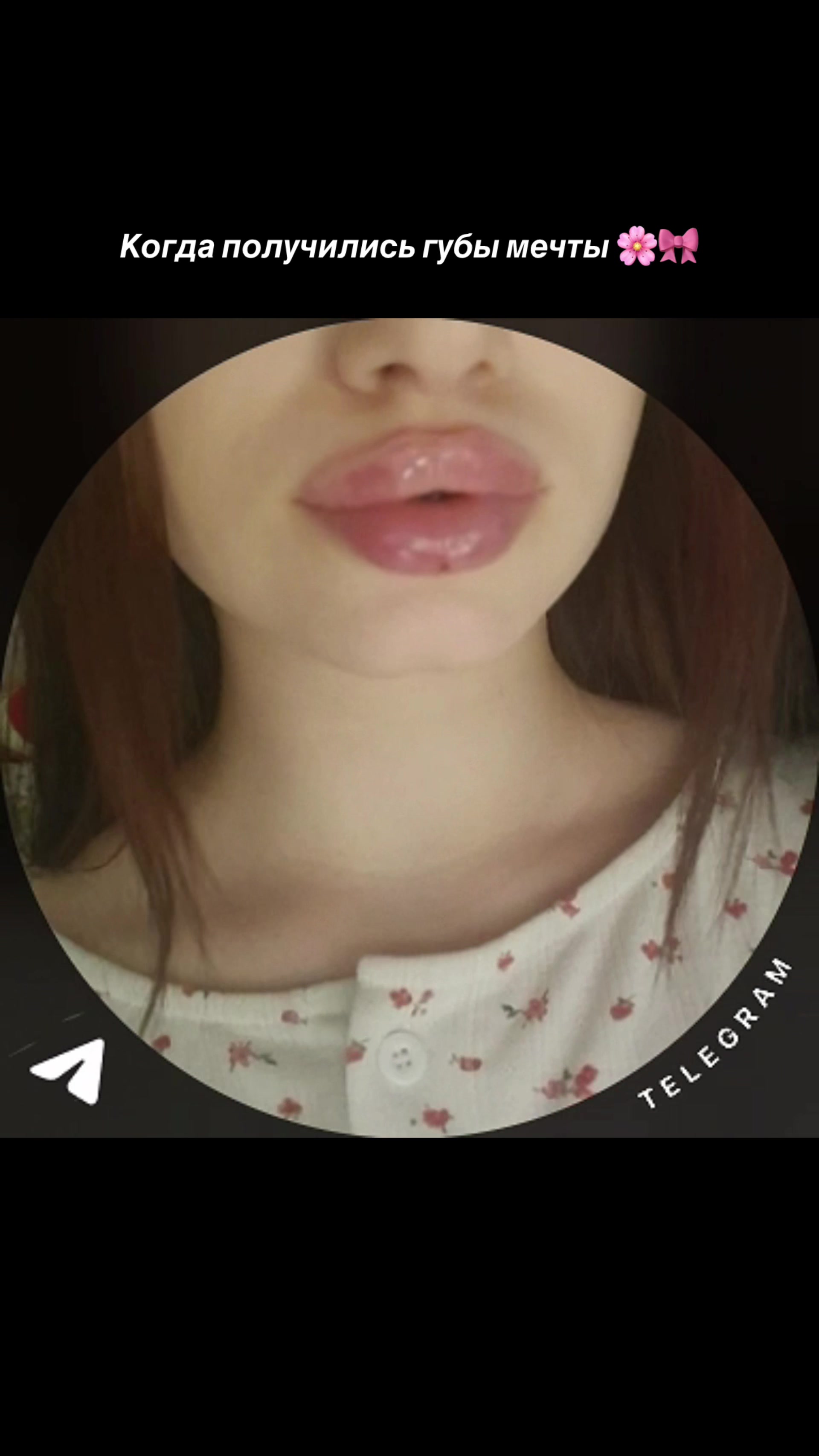 @КОСМЕТОЛОГ &bull; УВЕЛИЧЕНИЕ ГУБ