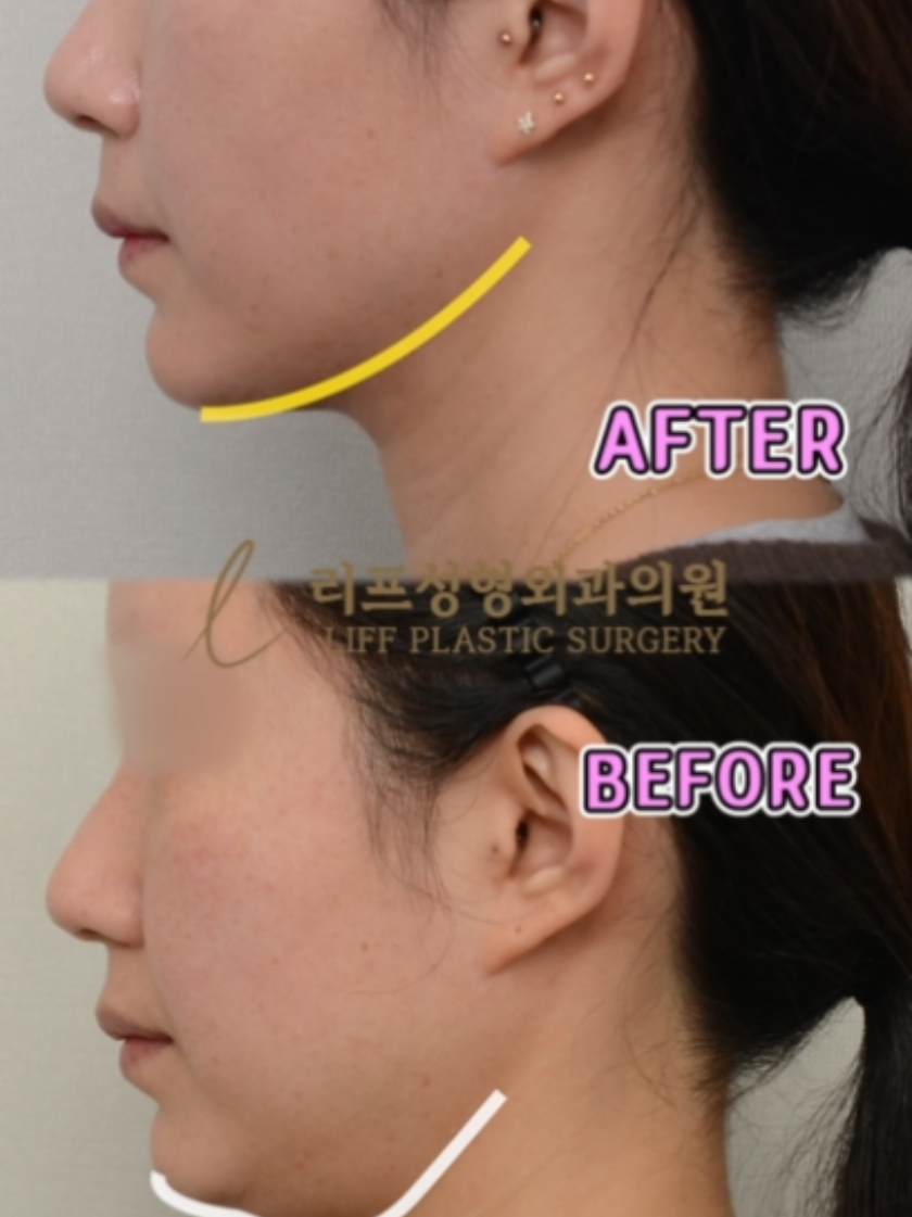 @리프성형외과 김기엽 대표원장