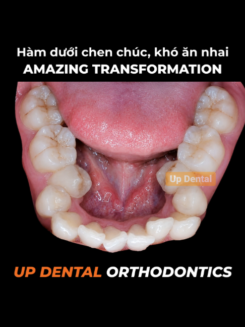 @Nha khoa niềng răng Up Dental
