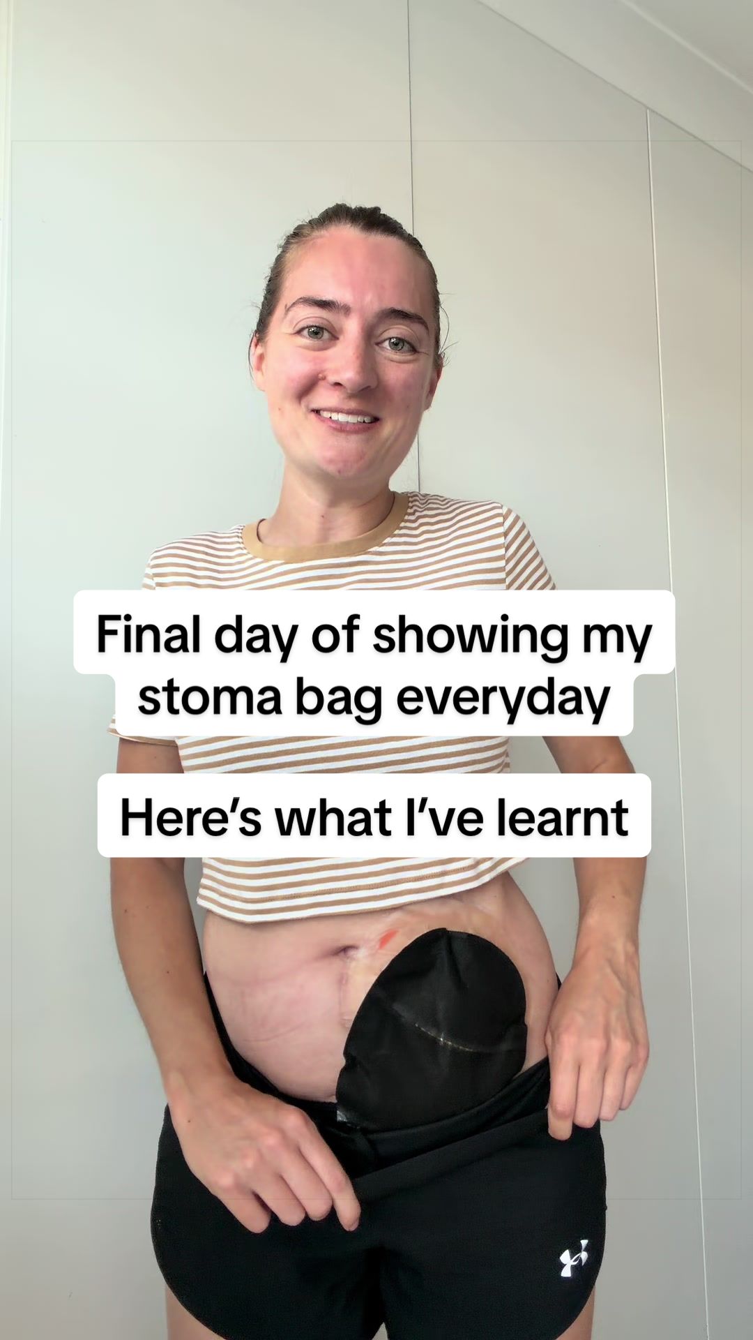 @Louise | Stoma & Crohns