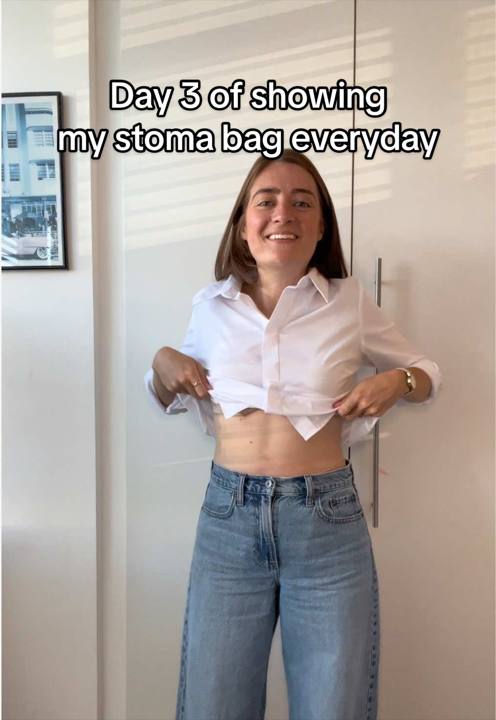 @Louise | Stoma & Crohns
