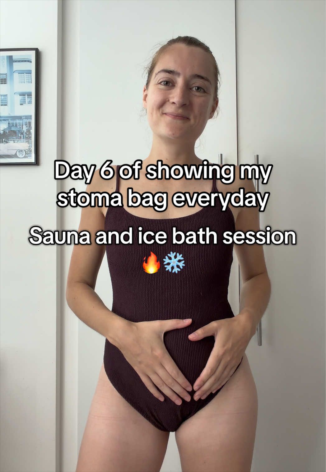 @Louise | Stoma & Crohns