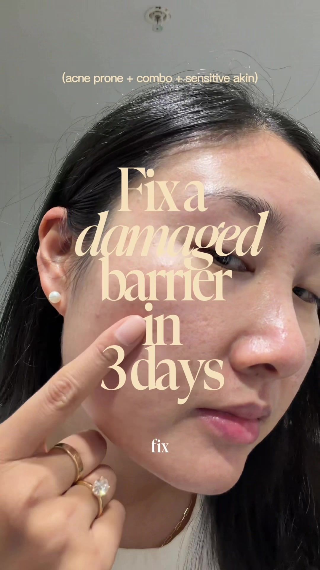 @Lisa | acne → clear skin