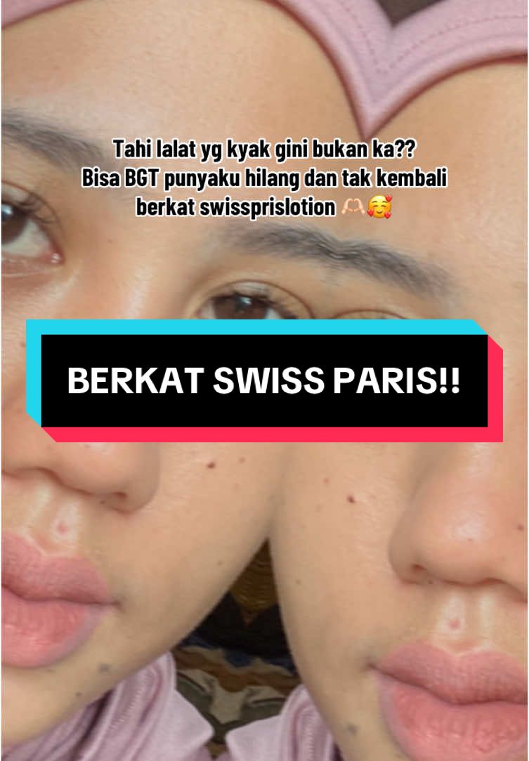@Penghilangtahilalat.kaq.ay