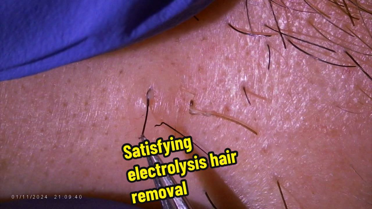 @Neurospice Beauty Electrolysis