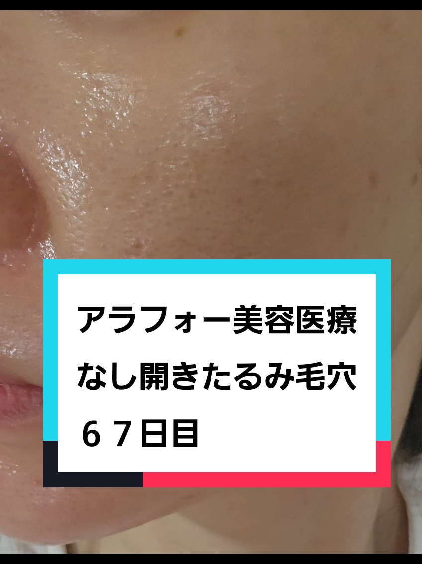 @リアル毛穴改善記録