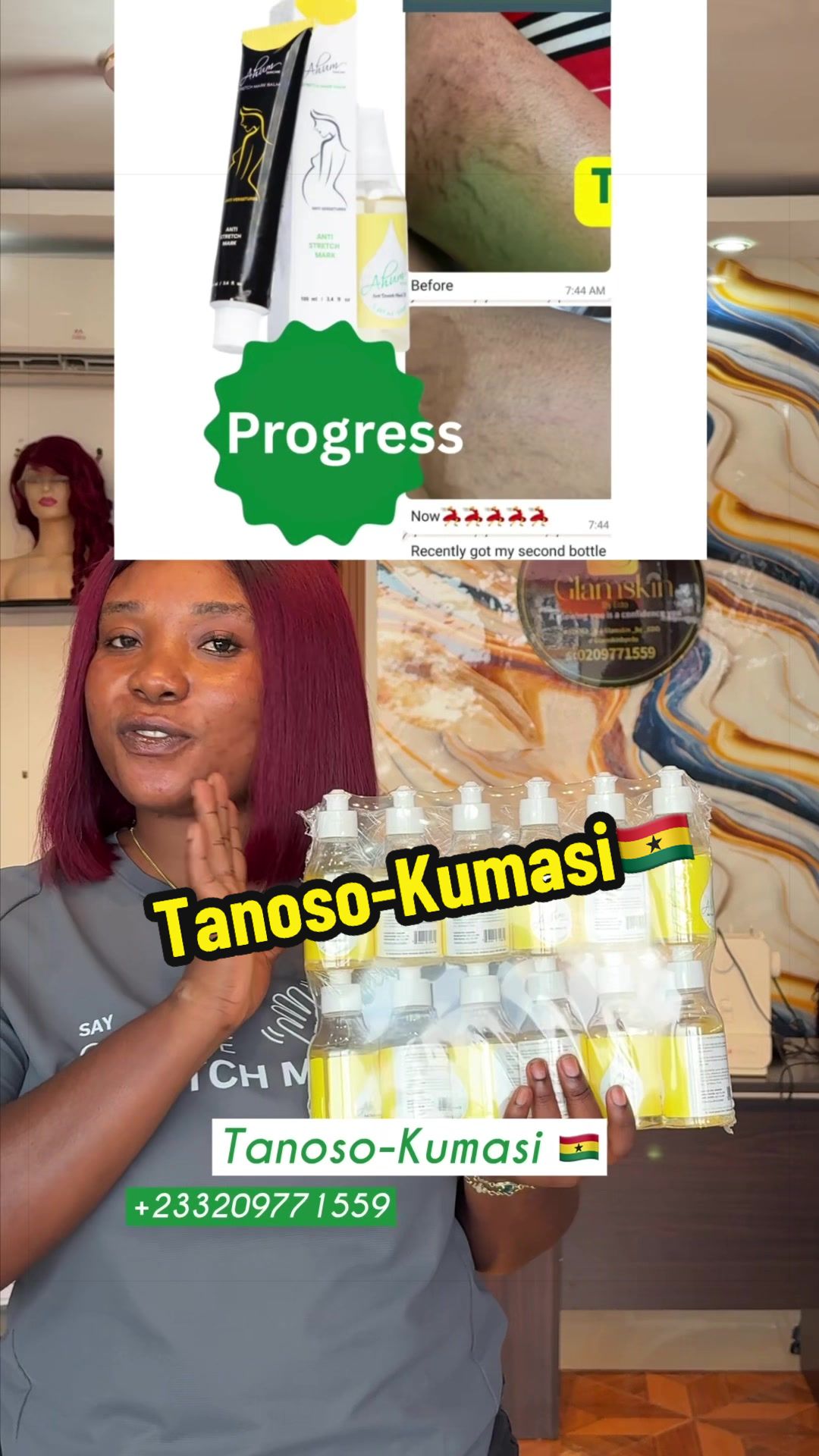 @No1 STRETCH MARKS PRODUCT