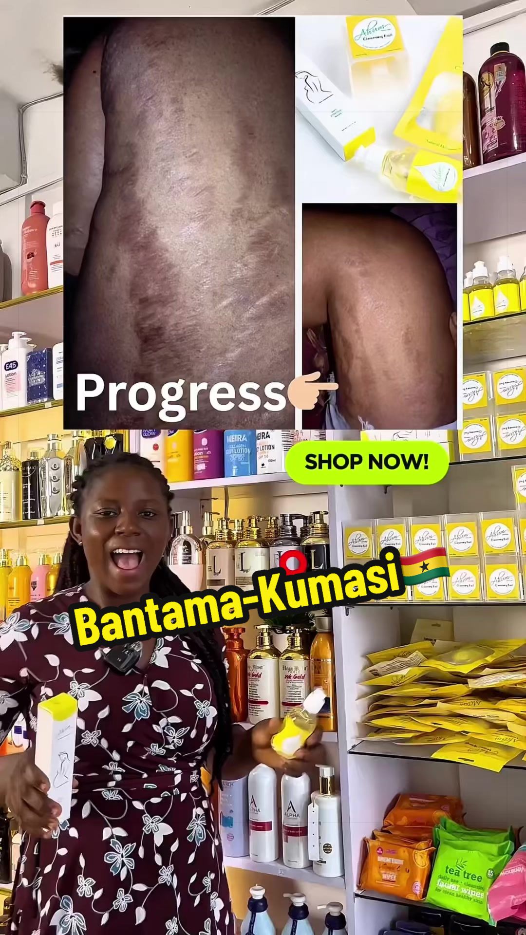 @No1 STRETCH MARKS PRODUCT