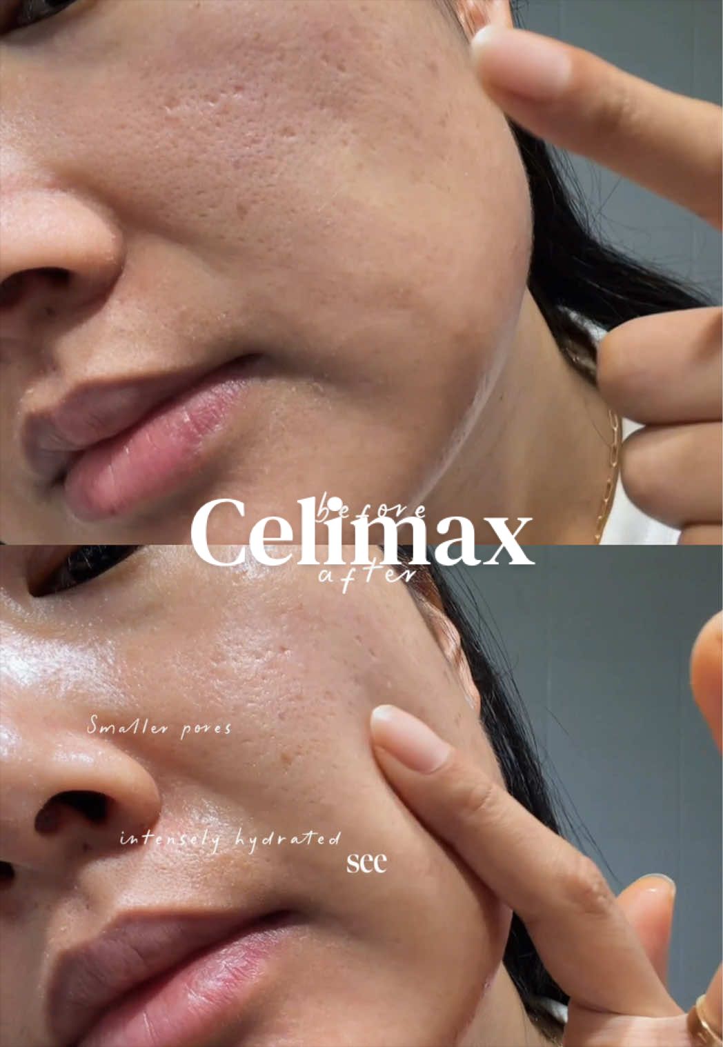 @Lisa | acne → clear skin