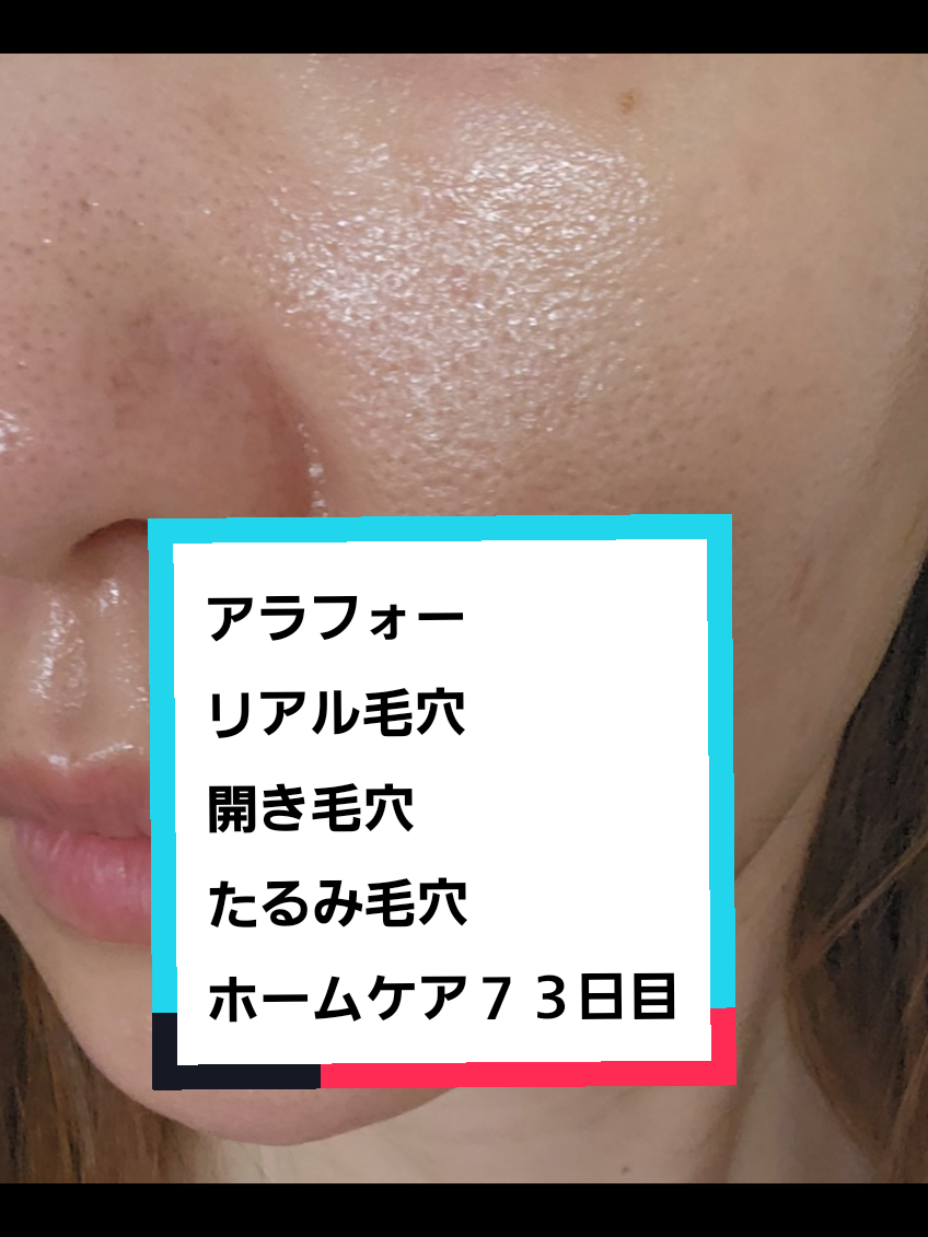 @リアル毛穴改善記録