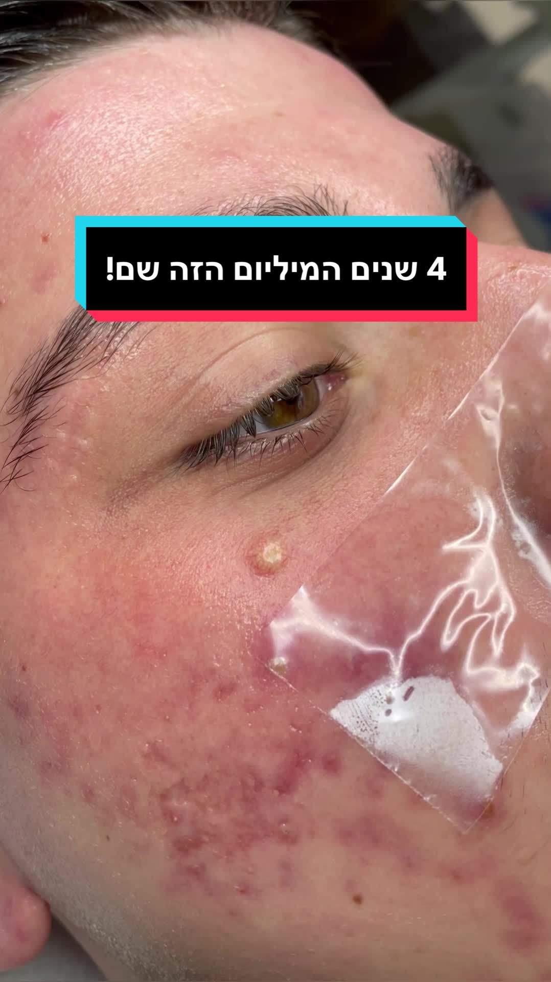 @תמר זריבץ - אקנה ופוסט אקנה
