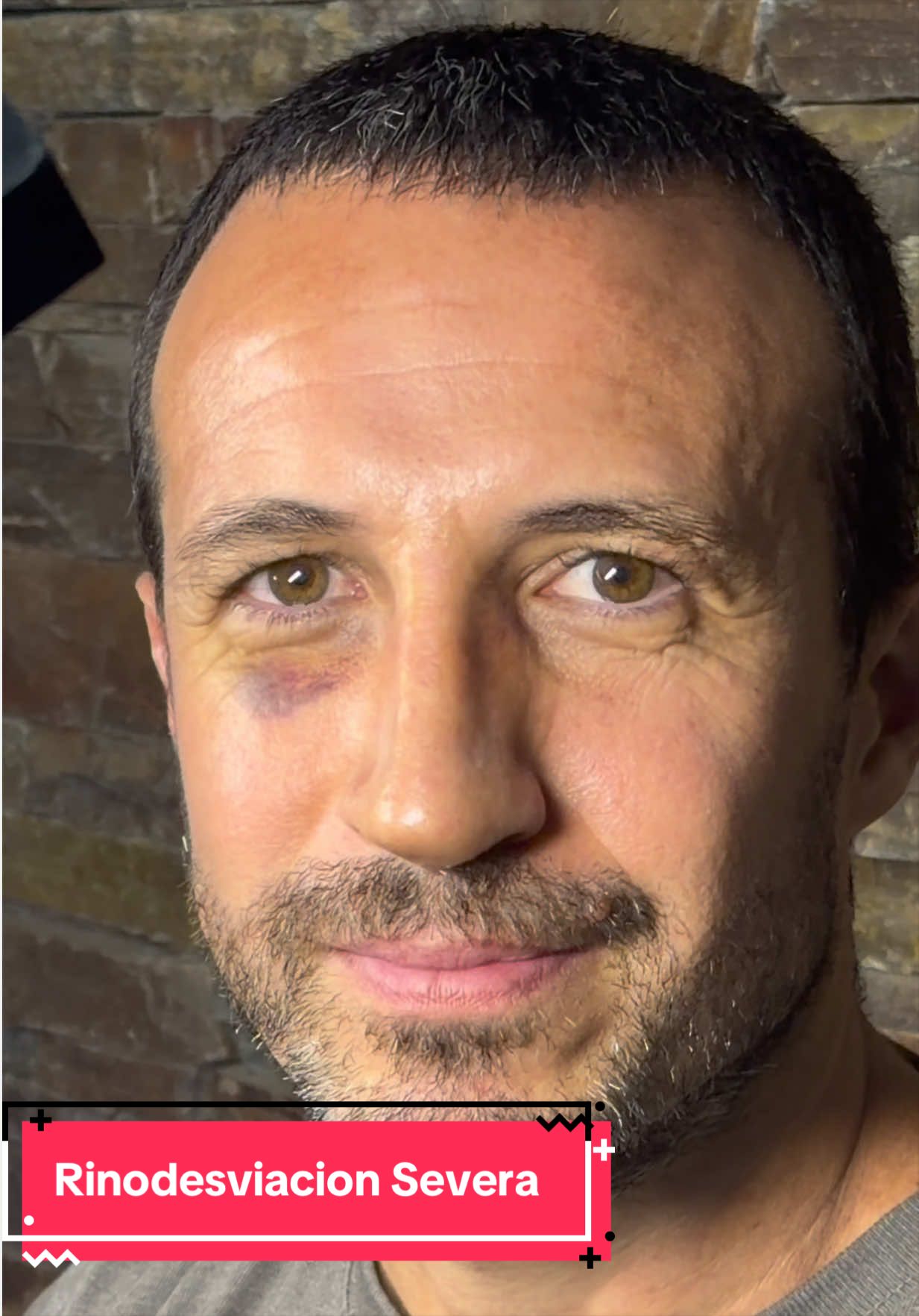 @drgarone.rinoplastia