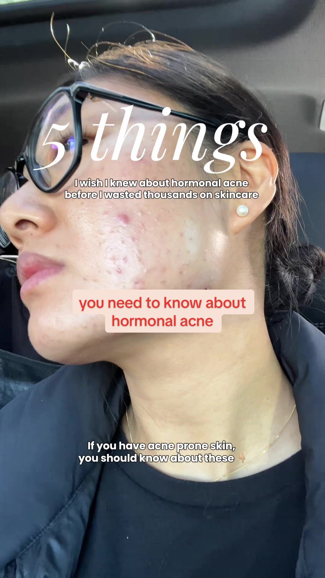 @Lisa | acne → clear skin