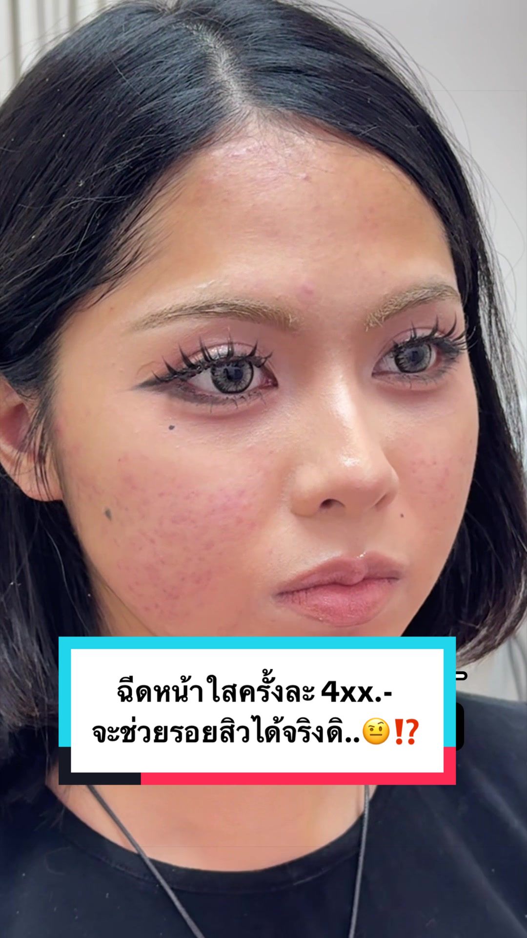 @Aura Xpress ฉีดหน้าราคาน่ารัก