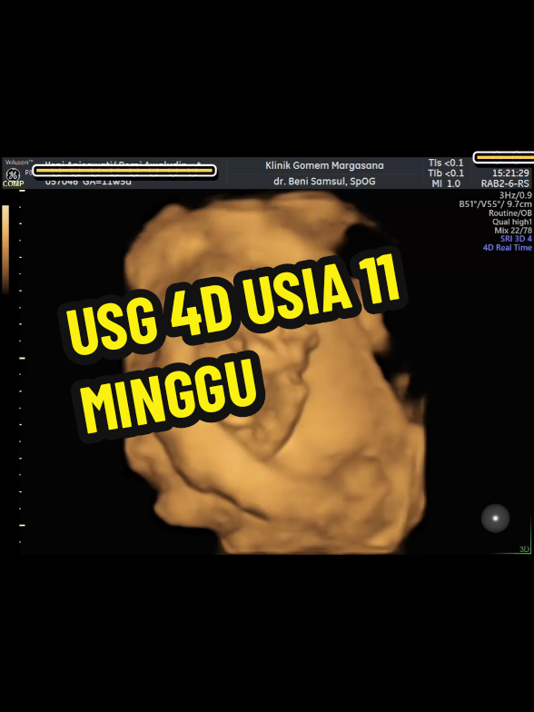 @USG 4D PURWOKERTO