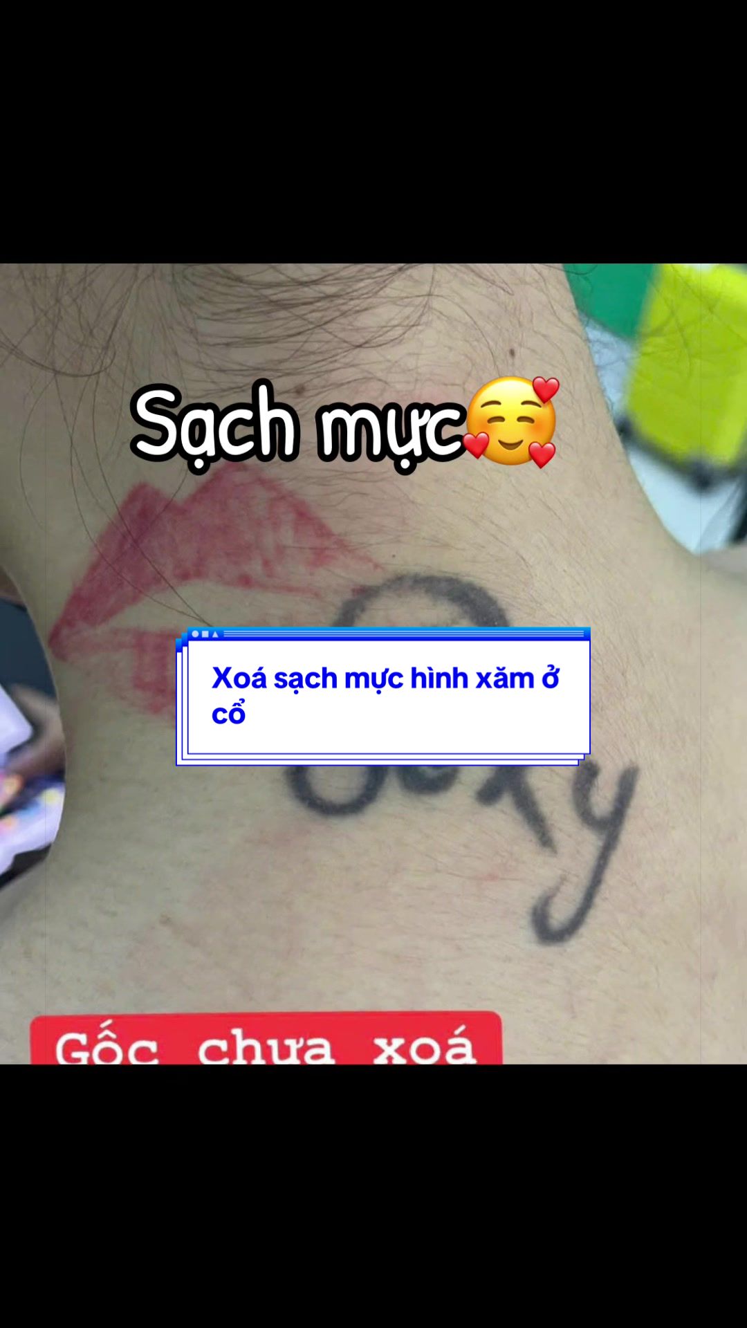 @Xo&aacute; xăm k sẹo H&agrave; Nội💧
