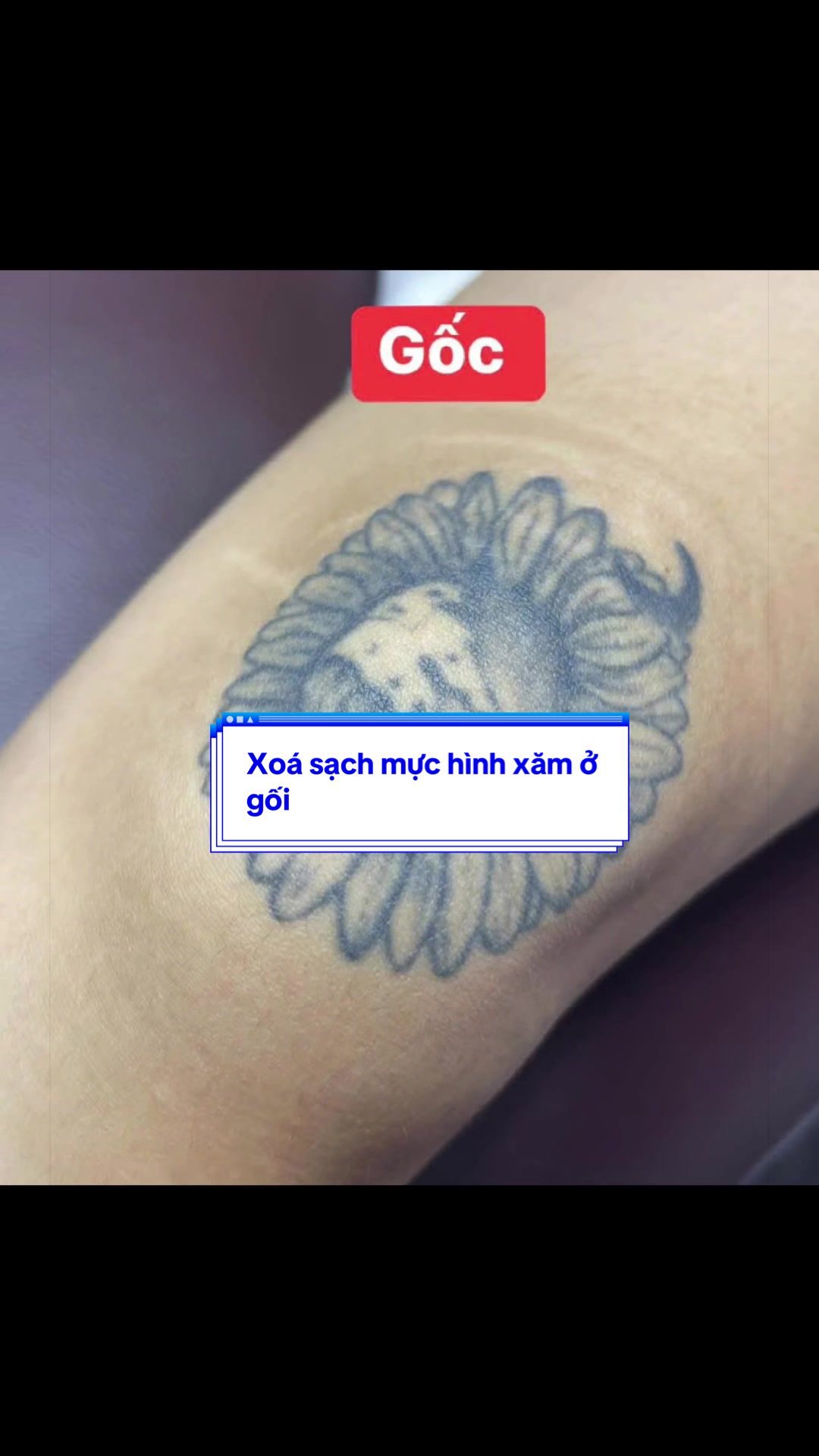 @Xo&aacute; xăm k sẹo H&agrave; Nội💧