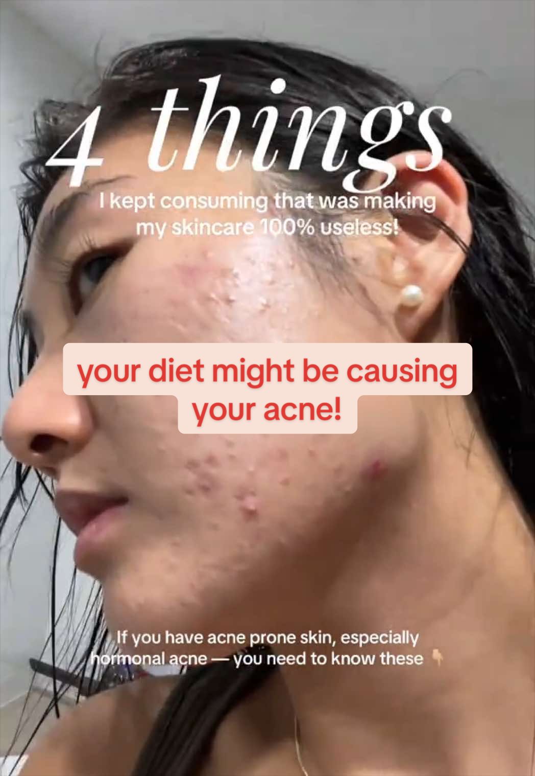 @Lisa | acne &rarr; clear skin