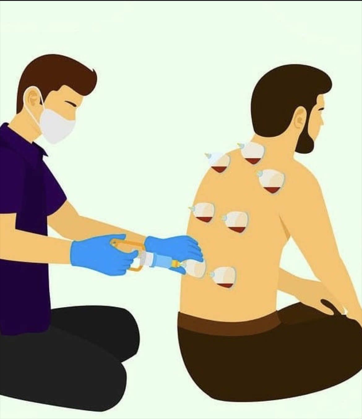 @Rashid 🇿🇦 🇵🇰Hijama Cupping