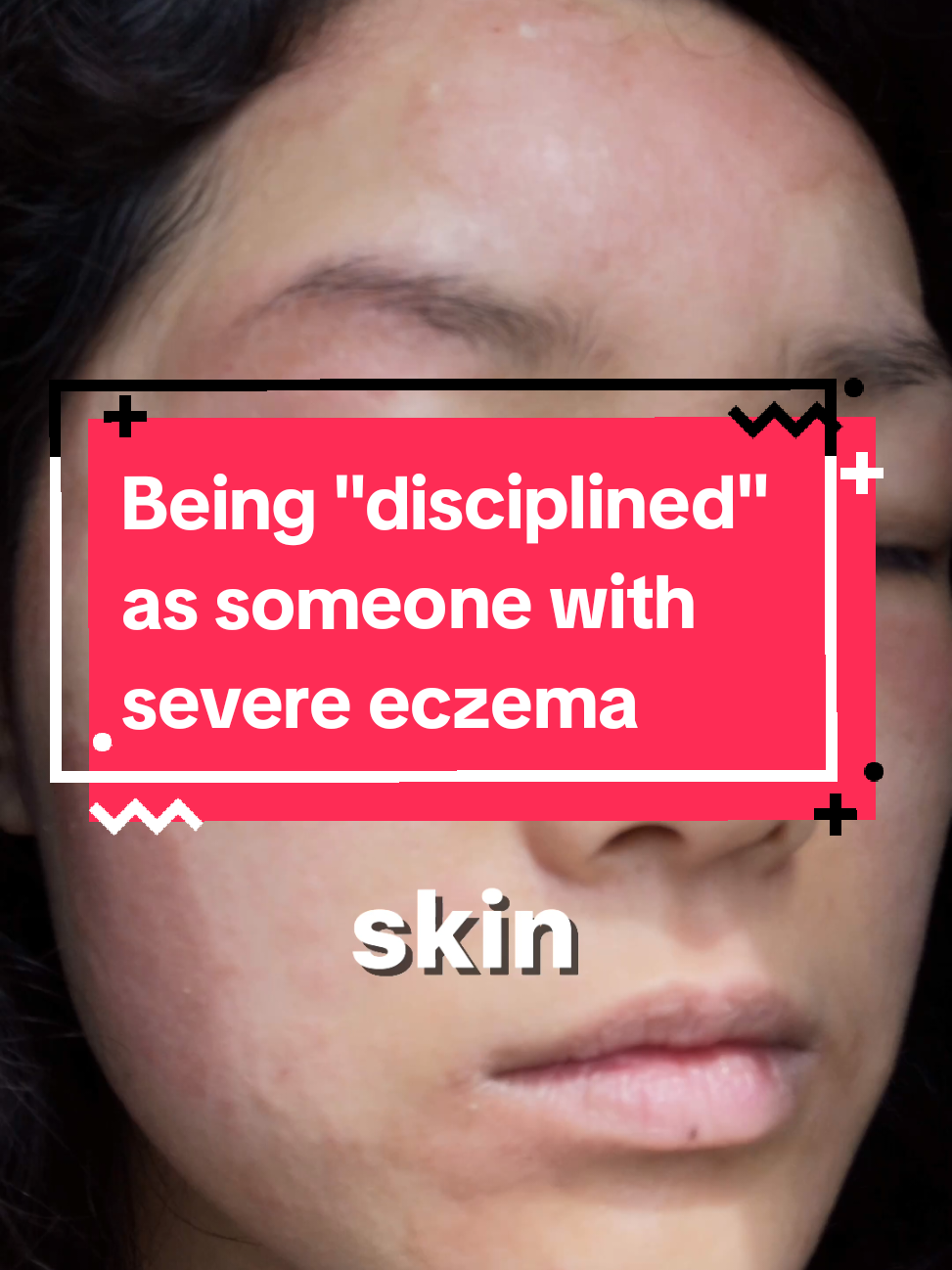 @Grace | TSW & Eczema Recovery